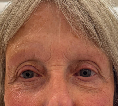 Semi Permanent Eyebrows Beau Clinic Kent