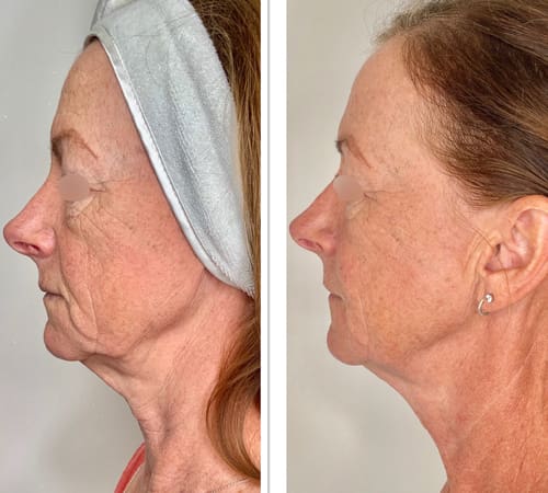 Morpheus8 Results Beau Clinic Ashford Kent