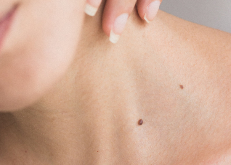 Skin Tag / Verruca Removal London Clinic Beau
