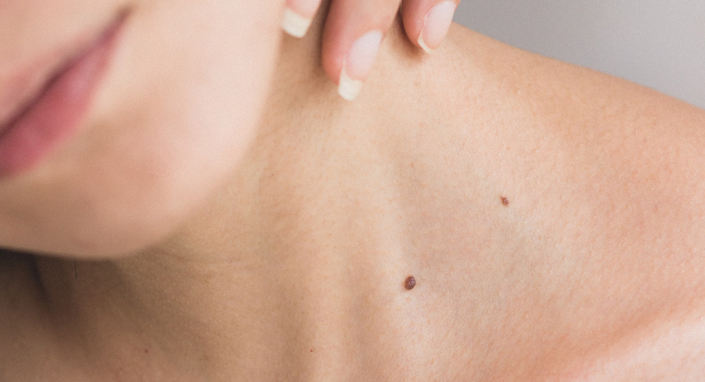 Skin Tag / Verruca Removal London Clinic Beau