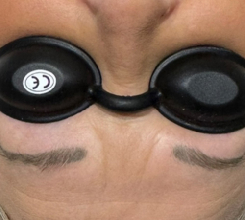 Permanent Makeup Removal Eyebrows Kent