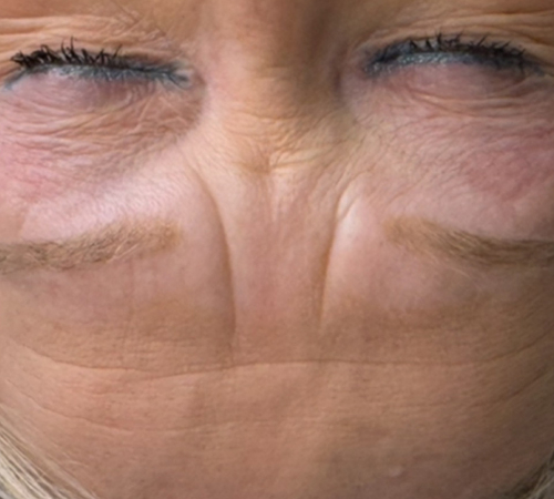 Permanent Makeup Removal Eyebrows Kent