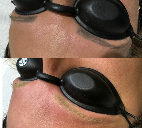 Permanent Makeup Removal Eyebrows Kent