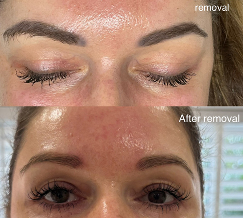 Permanent Makeup Removal Eyebrows Kent