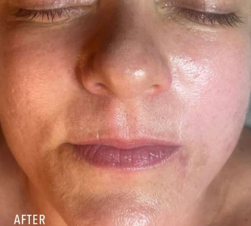 Hydro Glass Facial Beau Clinic Kent After