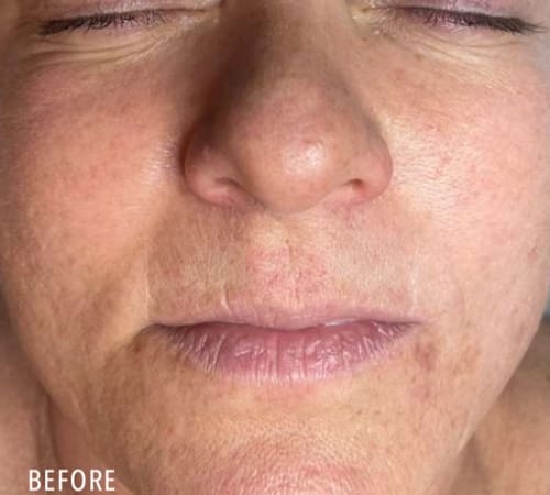 Hydro Glass Facial Beau Clinic Kent Before