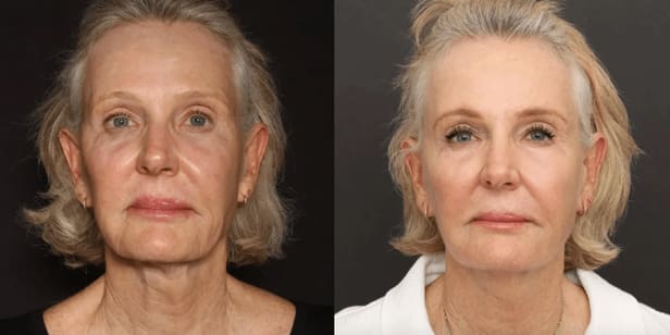 Sofwave-Kent-Blog-Before-and-After