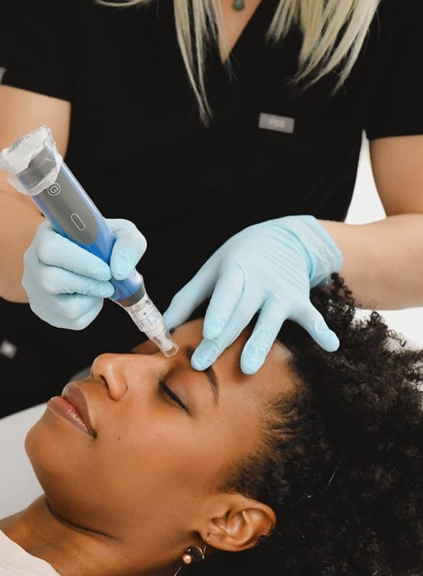 Microneedling skin rejuvenation treatment at Beau Clinic in Kent