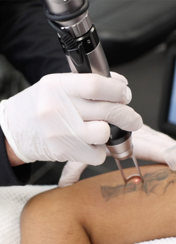 tattoo removal Kent
