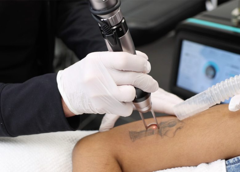 tattoo removal Kent