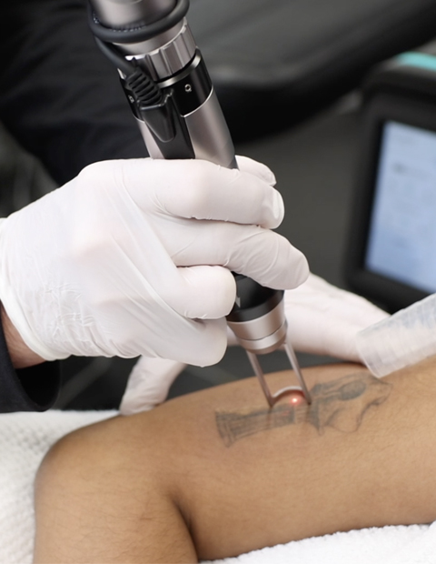 tattoo removal Kent