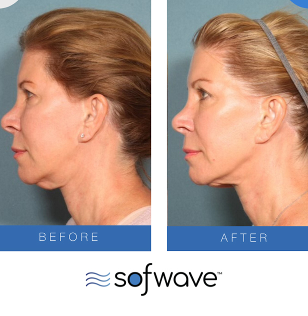Sofwave skin tightening Kent