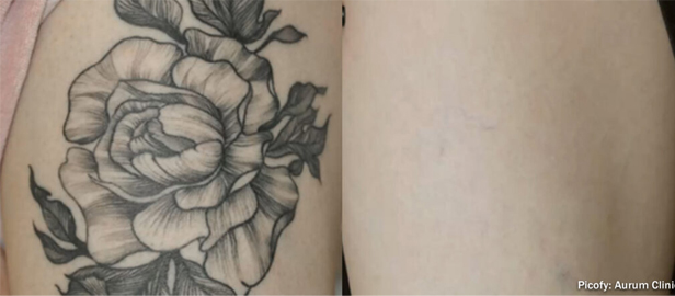 PicoFy Tattoo Removal in Kent Fade or Remove Unwanted Tattoos