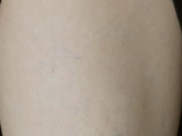 Picofy Tattoo Removal Kent