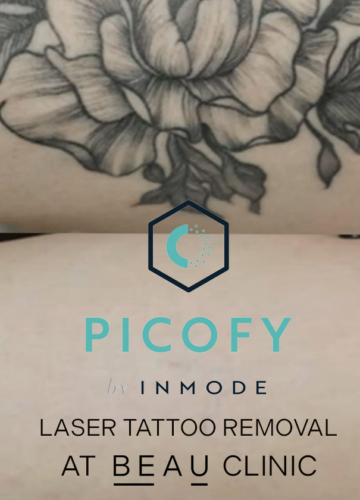 Picofy Laser Tattoo Removal Kent