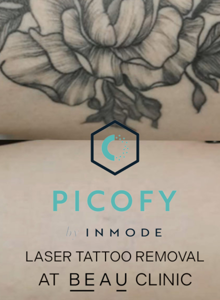 Picofy Laser Tattoo Removal Kent