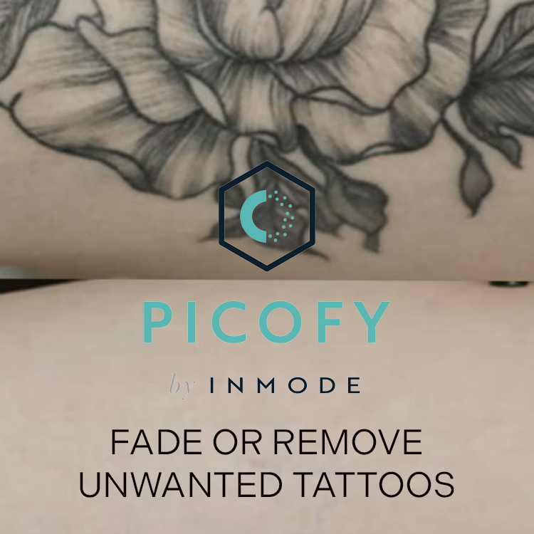 Tattoo Removal Kent