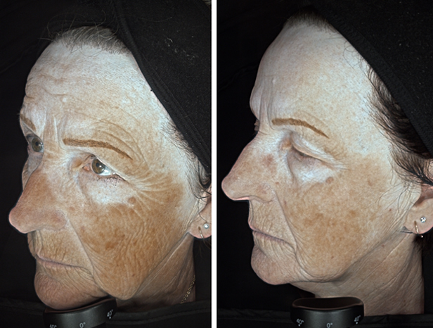 Lumecca IPL pigmentation treatment before and after at Beau Clinic