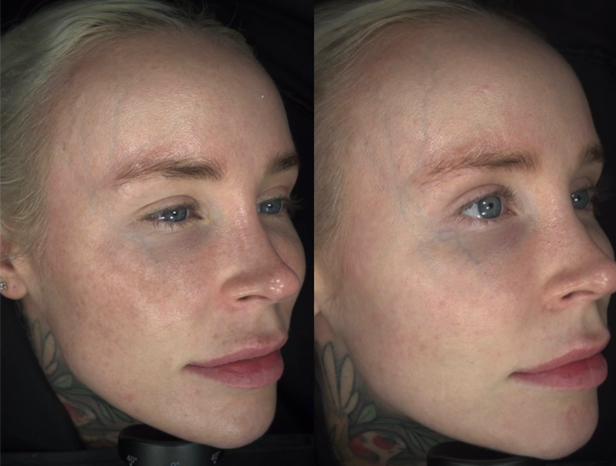 Lumecca IPL sun damage before and after results