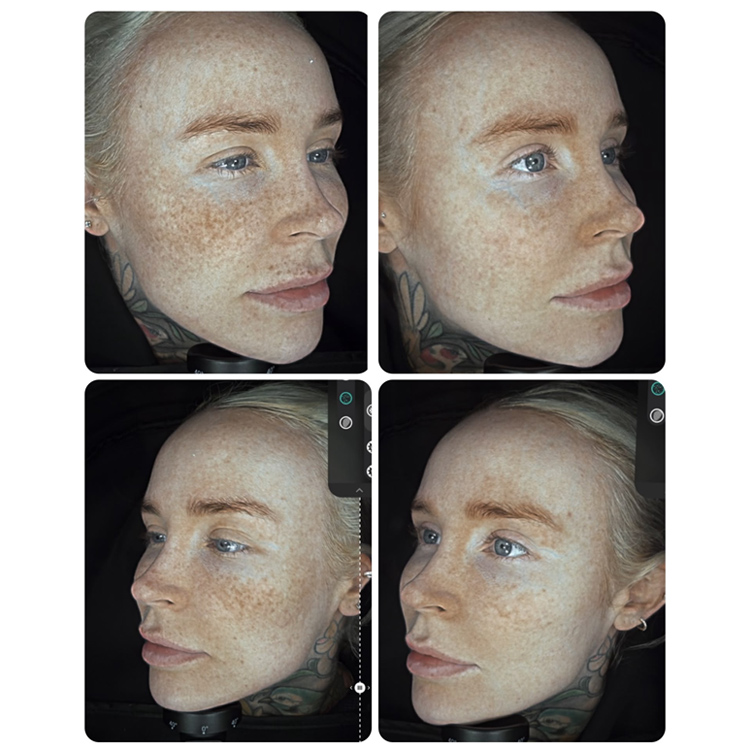 Pigmentation and sun damage treatment results at Beau Clinic Kent