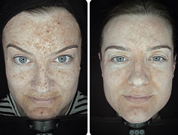 Obagi Nu-Derm pigmentation skincare before and after results