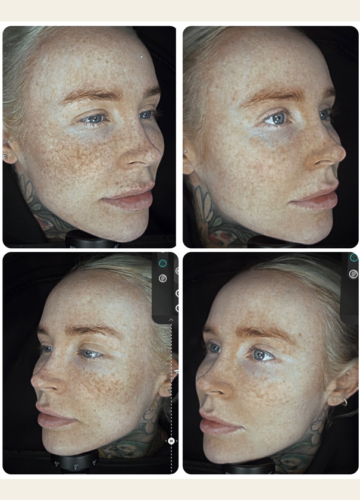 September is pigmentation season