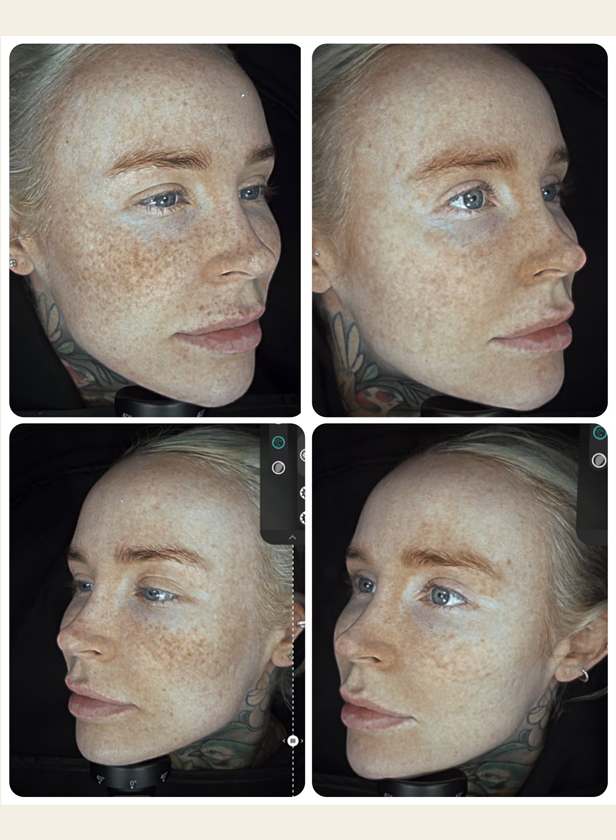 September is pigmentation season